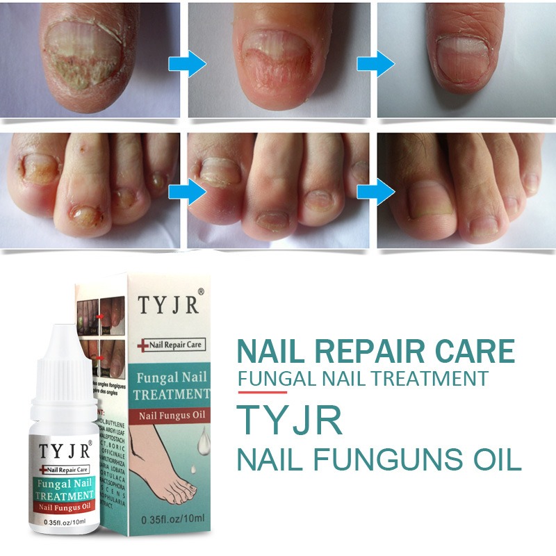 10ML-Fungal-Nail-Treatment-Nail-Nutrient-Solution-Repair-Nail-Moisturizing-Nail-Care-Tool-1331643